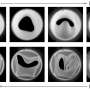 What pig hearts and a little noise can teach us about designing better soft valves